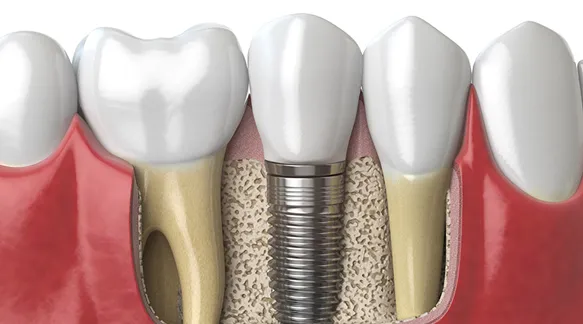 Implante Dental Marbella