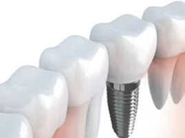 implante dental marbella